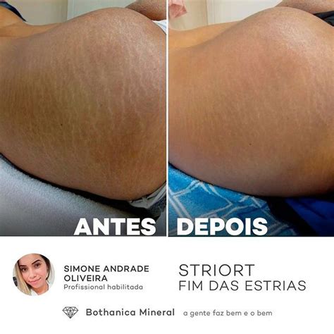 striort antes e depois|Striort para estrias: como funciona e antes e depois .